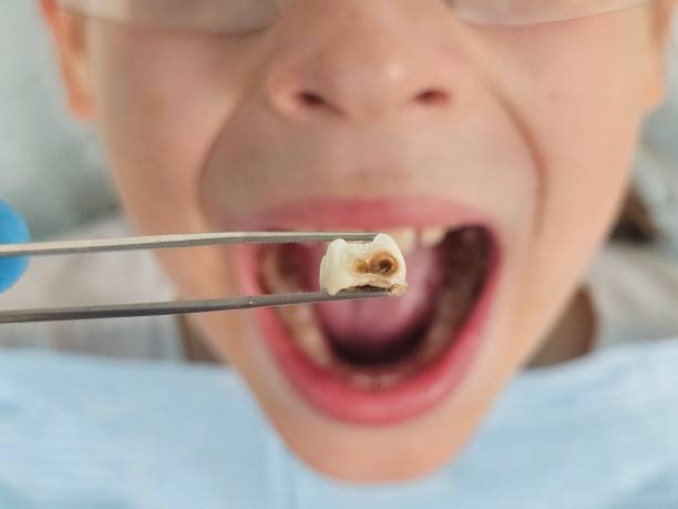 Best Emergency Wisdom Teeth Removal in River Grove, IL